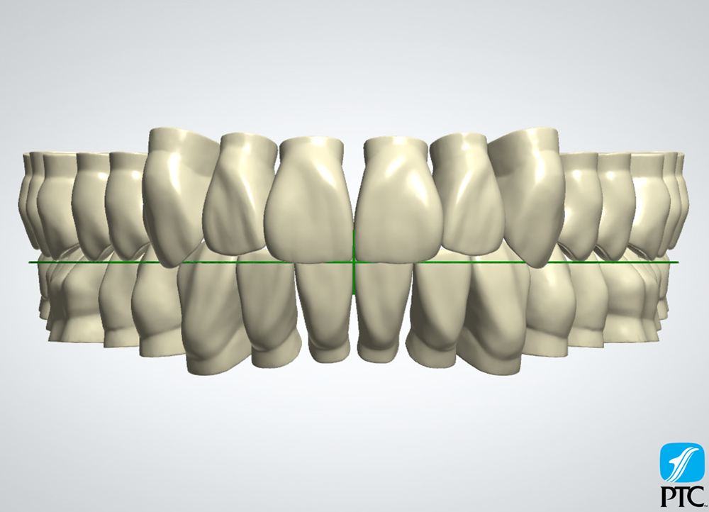 PTC Ness Teeth