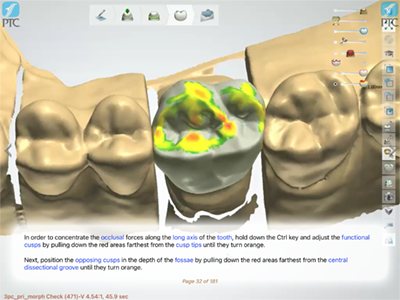 Occlusal Stops